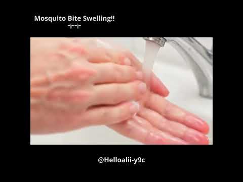      طرق للتعامل مع انتفاخ قرصة البعوض    