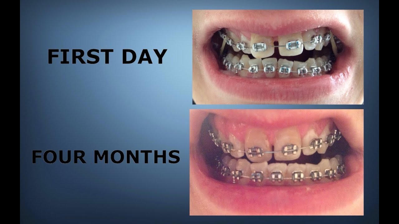 Braces 0 4 Months Time lapse Braces Progress YouTube