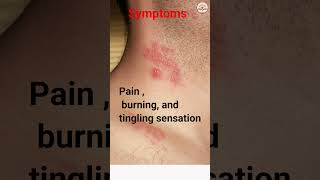 shingles | herpes zoster virus symptoms #shorts