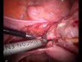 Total laparoscopic hysterectomy drnutan jain india