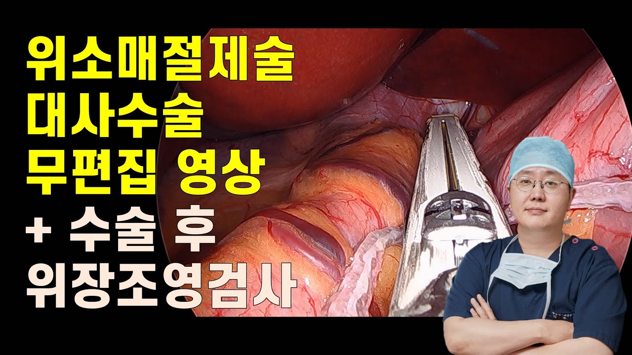 위소매절제술 대사수술 무편집 FULL 영상, 수술 후 위장관 조영술 검사 영상