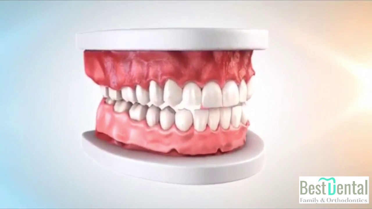 Dentures in Houston, TX YouTube