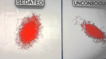 MacIver Anesthesia EEG