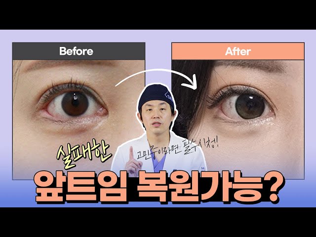 망한 앞트임, 다시 돌아갈 수 있어요  #앞트임복원 #미호성형외과