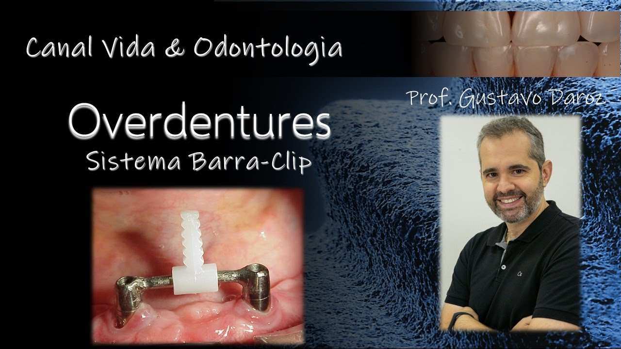 Sistema Barra-Clipe para Retenção de Overdentures sobre Implantes Dentários