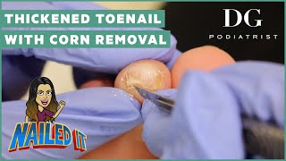 Thickened toenail with corn removal treatment: subungual corn | The Foot Scraper: DG Podiatrist