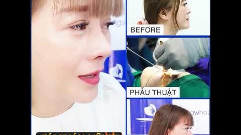 REVIEW NÂNG MŨI NANOFORM BÁC SĨ PHÙNG MẠNH CƯỜNG