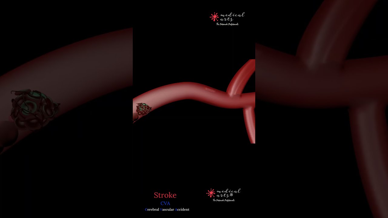 Ischemic Stroke By A Blood Clot CVA Cerebral Vascular Accident Animation