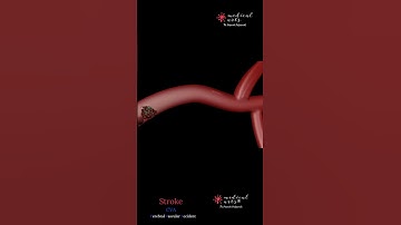 Ischemic Stroke By A Blood Clot | CVA | Cerebral Vascular Accident | Animation