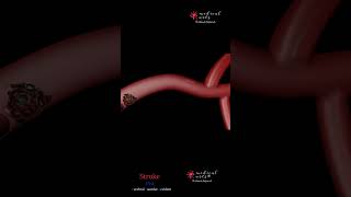 Ischemic Stroke By A Blood Clot | Cva | Cerebral Vascular Accident | Animation