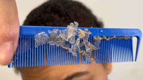 My flakes after one week of scratch #psoriasis #asmr #dandruffremoval