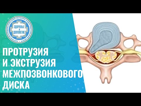 ✅ Протрузия и