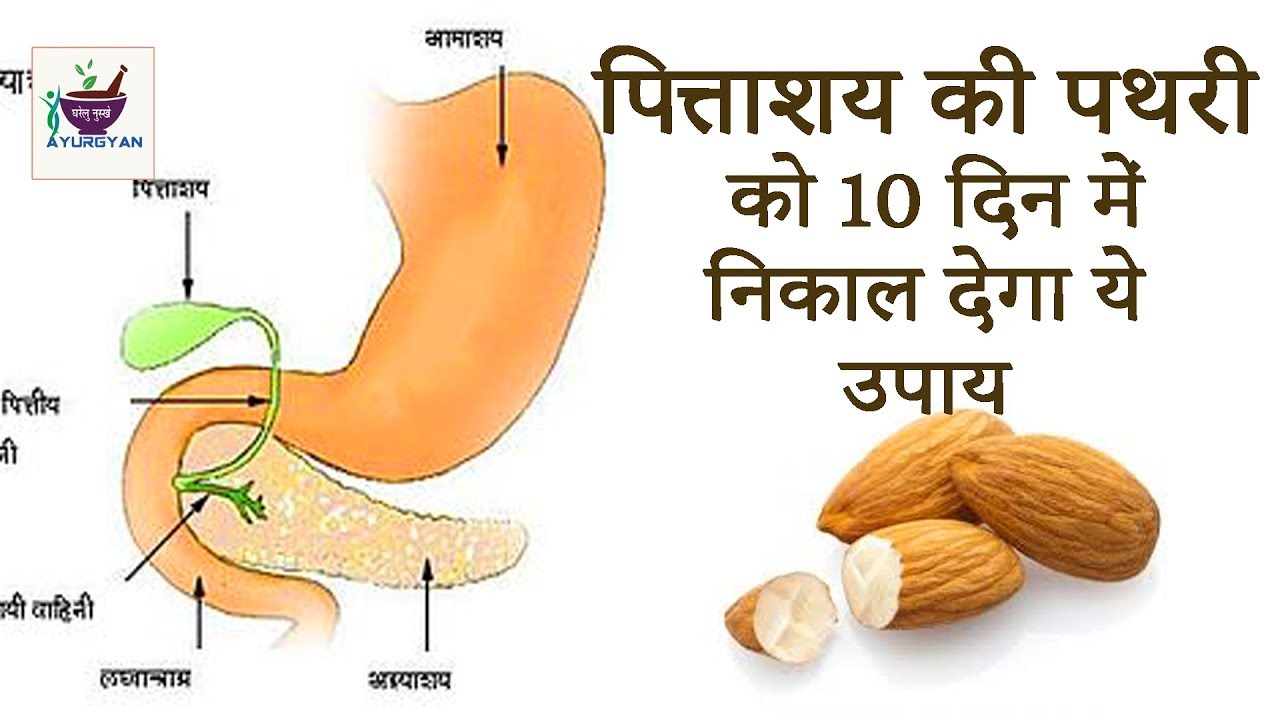 पित्ताशय की पथरी को 10 दिन में निकाल देगा ये उपाय Cure your stone