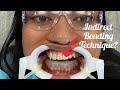 Time lapse process of having braces put on at bowen orthodontics indirect bonding technique