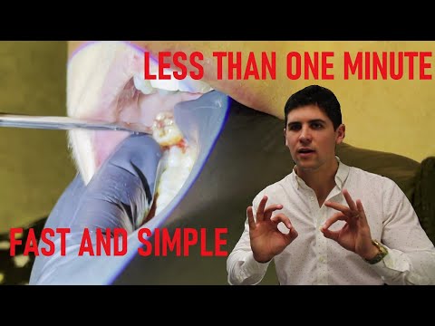 Wideo: Czy wyrzynające się zęby mądrości są łatwiejsze do usunięcia?