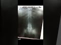 زحزحة بالفقرات و انزلاق غضروفي انزلاق غضروفي زحزحة الفقرات جراح عمود فقري Subscribe 