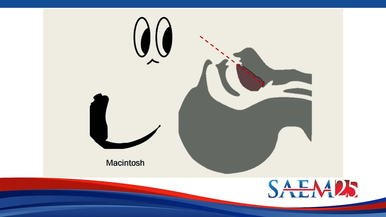 Laryngoscopy in 2024- What the Evidence Reveals (Airway Interest Group-Sponsored)