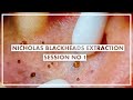 Nicholas 1st Session - Ear, Forehead and Cheeks Blackheads Extraction