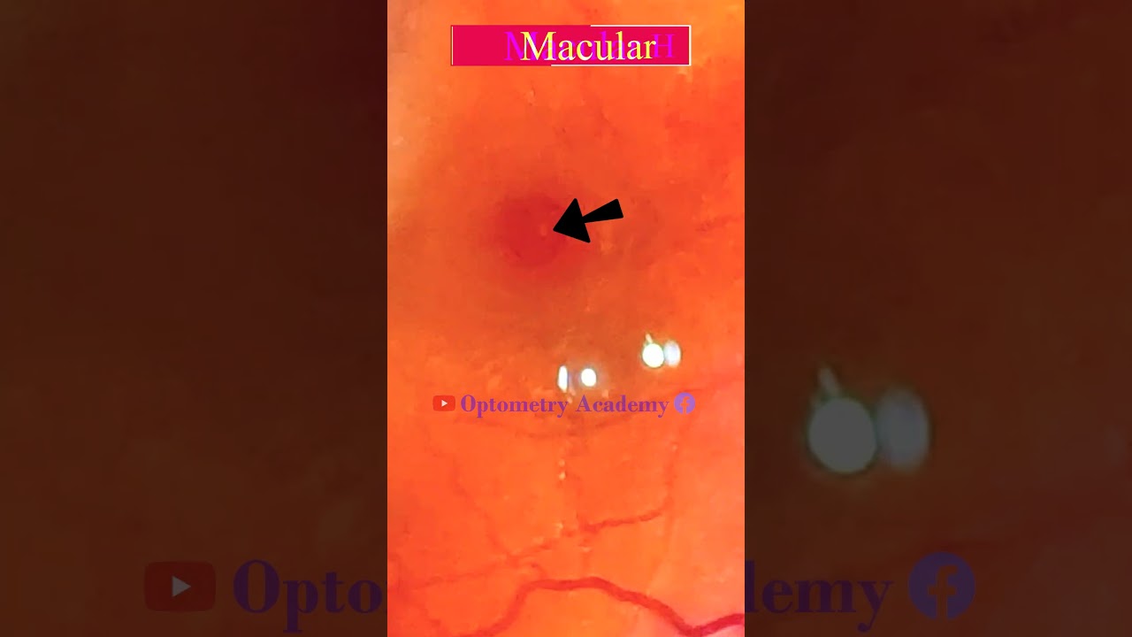 Macular Hole | Full thickness Macular Hole | Smartphone Fundus Videography | Short Video 326