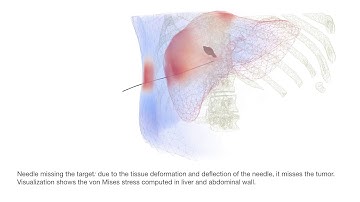 Simulation of a flexible needle insertion into a deformable model of tissue