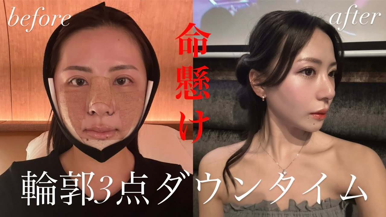 #01 壮絶な輪郭3点ダウンタイムin韓国