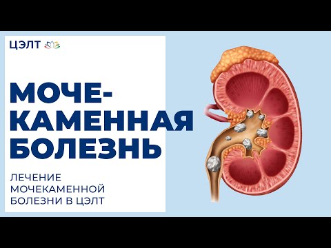 🔷 Мочекаменная болезнь. Лечение мочекаменной болезни в ЦЭЛТ