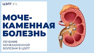 🔷 Мочекаменная болезнь. Лечение мочекаменной болезни в ЦЭЛТ