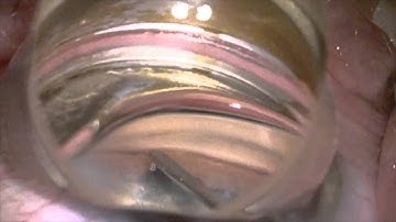 iStent placement by Steven G. Safran MD