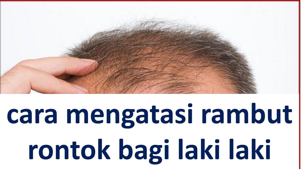 Cara Mengatasi Rambut Rontok Bagi Laki Laki YouTube