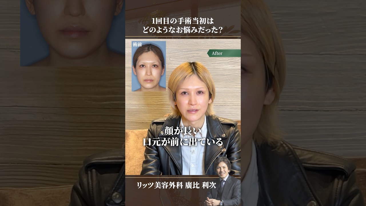 骨切りを受けた患者様にインタビュー#骨切り #美容整形 #輪郭形成 #shorts
