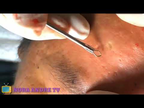 Blackhead Remove--get rid of pimples in the forehead and eye dial-rimuovere il comedone