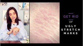 Remove Stretch Marks at Home in a Week | Remedies to Remove Stretch Marks | Hacks | Juggun Kazim