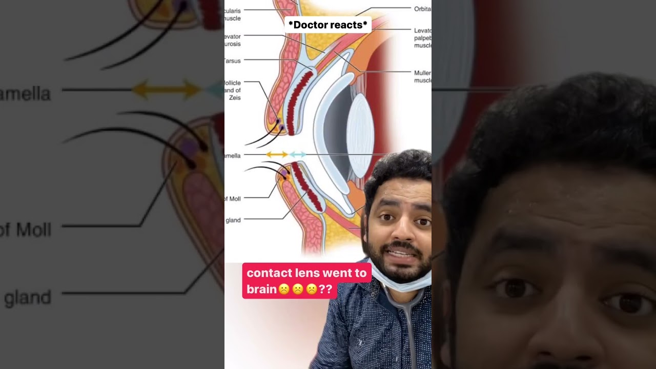 Doctor reacts: Eye contact Lens 
