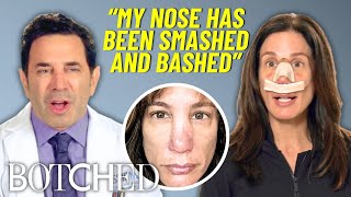 Stacies Nose Was Destroyed After 4 Accidents & 14 Surgeries Botched E