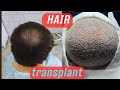 Hair transplant in Moscow/ Трансплантатсияи мӯй Дар Москва
