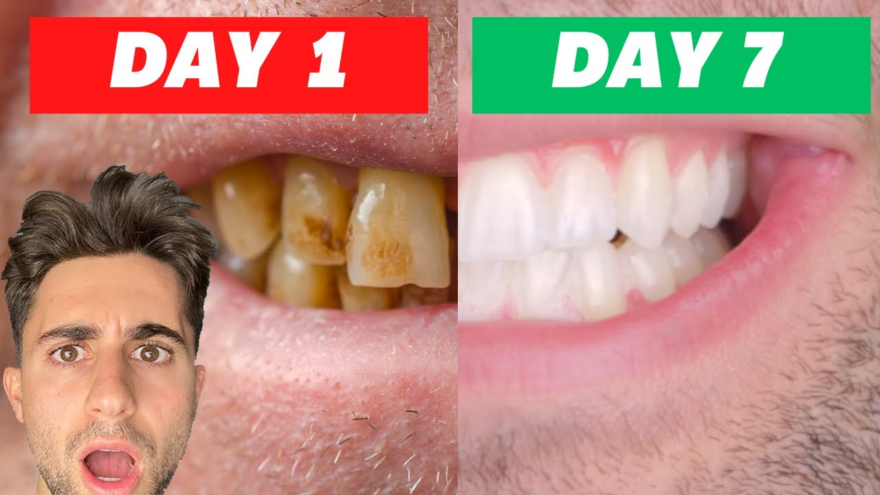 I Tried Crest Whitening Strips For 7 Days INSANE RESULTS (Honest