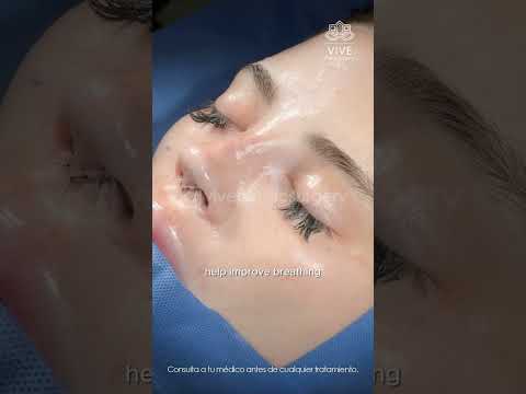 A Profile Designed for You 👃Rhinoplasty at Vive Plastic Surgery in #tijuana 🤩💖