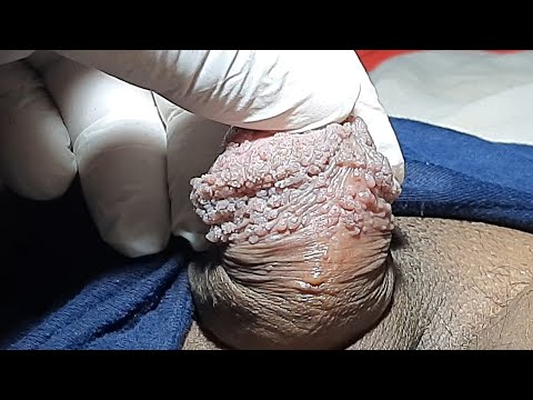 Video: Apakah Genital Warts Terluka? Plus 7 FAQ Lainnya Dijawab