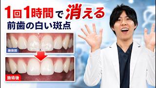 【裁断済み】ホワイトスポット 白い斑点は削らず治せる？】ホワイトスポットとアイコン治療を歯医者が