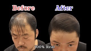 [hair loss] barber shop styling before after 탈모스타일링 탈모포마드 비포에프터 모든탈모인을 위한 영상 #hair #hailloss #barber