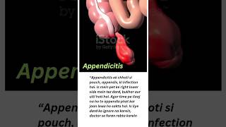 Appendicitis | Causes, Symptoms & Treatment Explained #viral #viralshorts