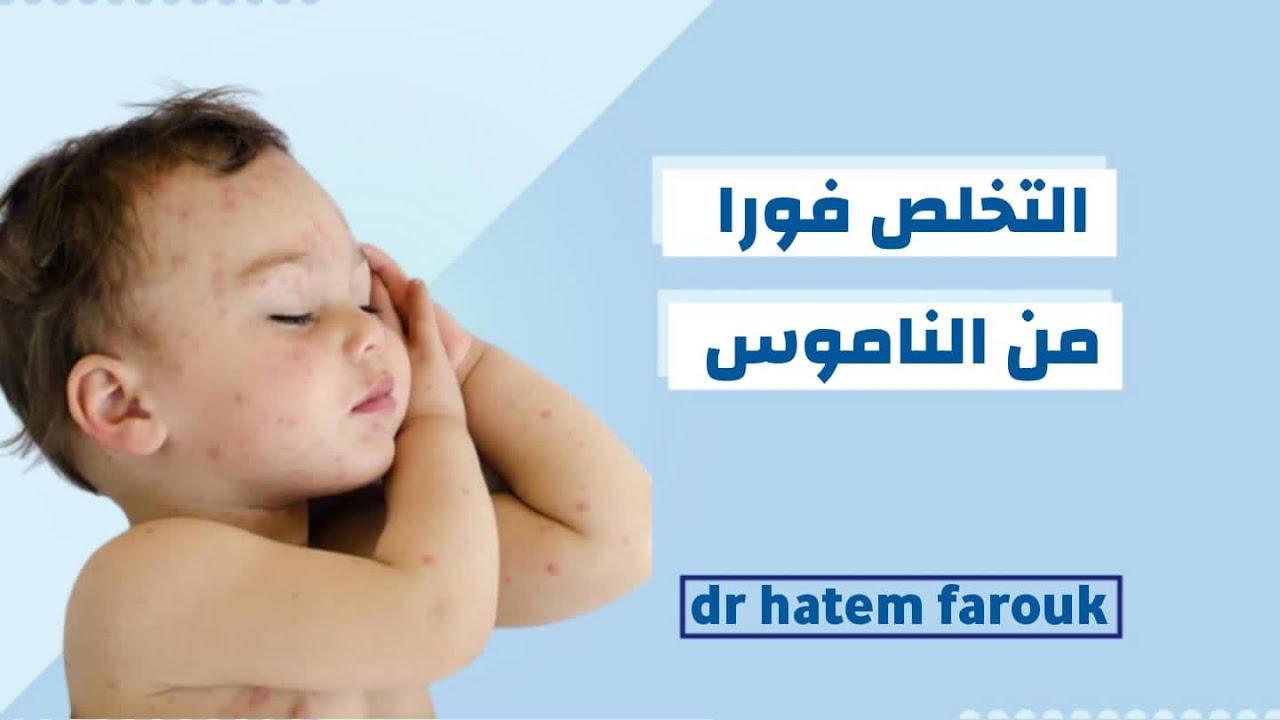 طرق فعالة للتخلص من الناموس نهائيا بدون إستخدام مبيدات حشرية وعلاج الطفل بمواد طبيعية فى الحال