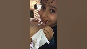 خلع سن عواشة 