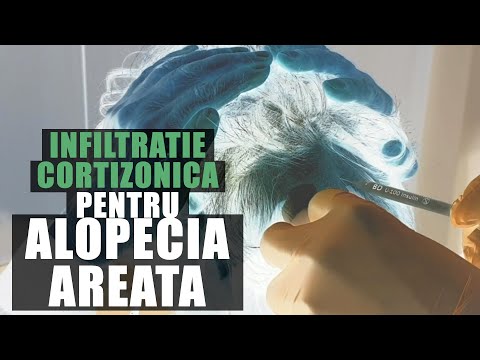 Video: Alopecia Areata: Cauze, Simptome și Diagnostic