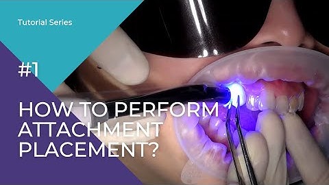 TrioClear® Tutorial Series #1 - How to perform Attachment Placement?