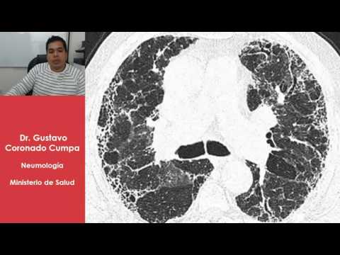 Vídeo: Diferencia Entre Enfermedad Pulmonar Intersticial Y Bronquiectasia