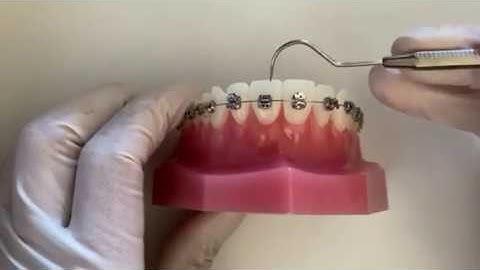 How to close a Bracket Clip