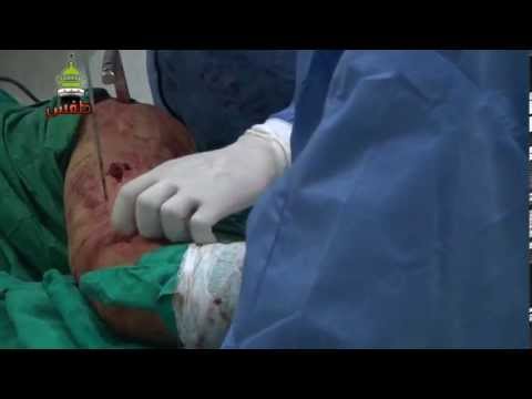 سرية مشفى طفس الميداني عملية كسر فخذ لمصاب من بلدة نافعة بدرعا