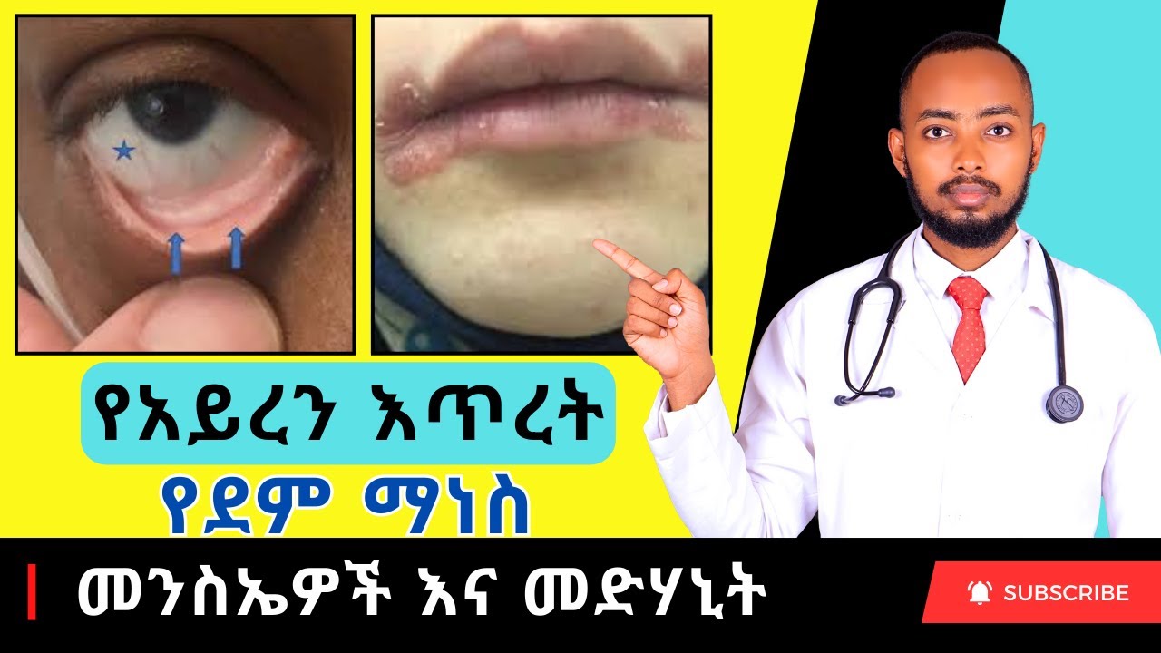 Ethiopia | የአይረን እጥረት የደም ማነስ ምልክቶች እና መፍትሄዎች