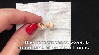 Удаление Зуба Мудрости. Зуб Мудрости Распиленный. Брекеты И Удаление Лежачей Восьмёрки.